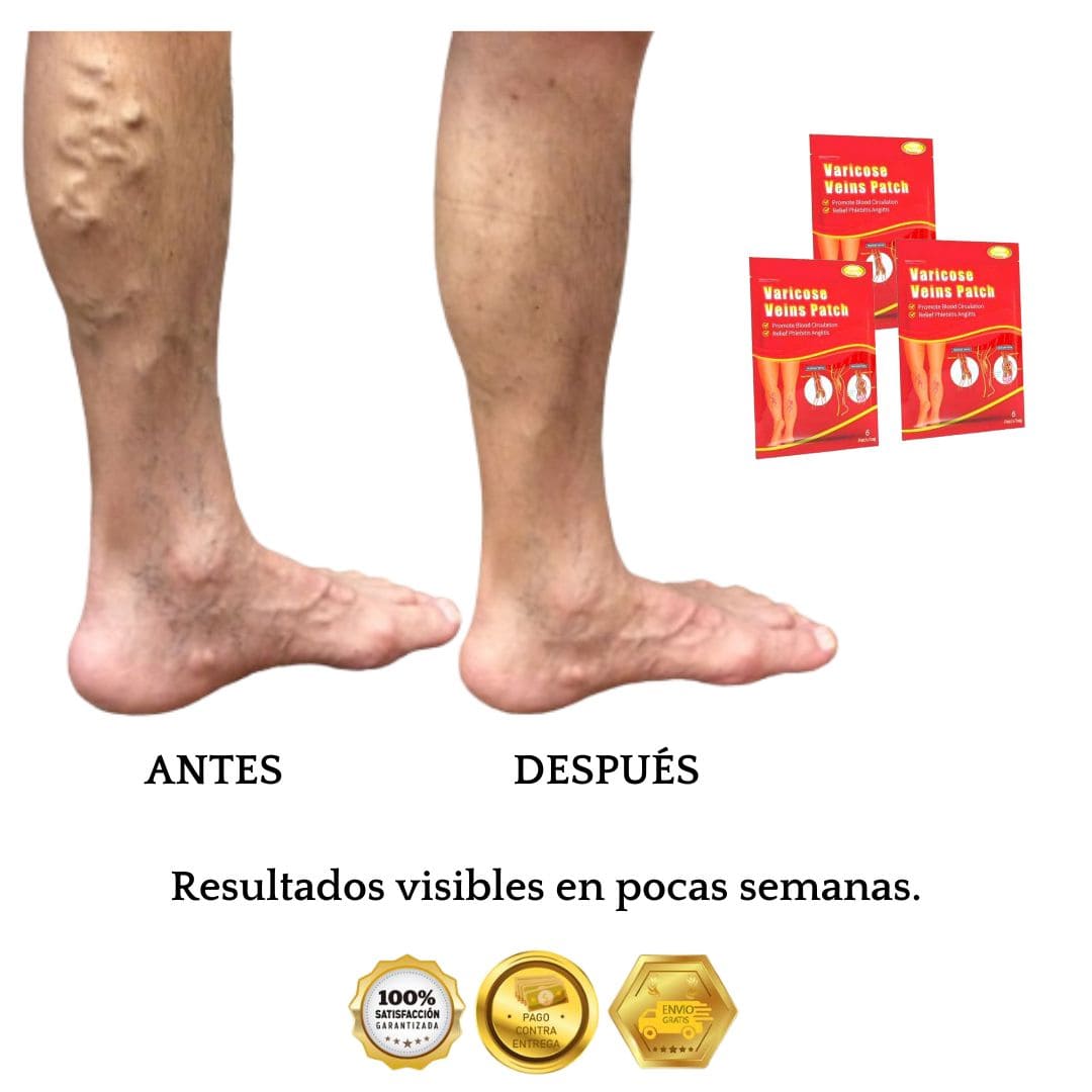 💖 Piernas Ligeras: 18 Parches Para Decir Adiós al Dolor y Várices en Pocos Días