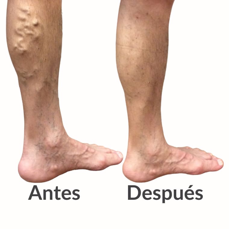 Parches Para Decir Adiós al Dolor y Várices en Pocos Días