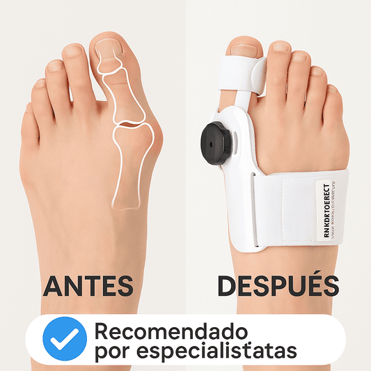 Adiós al Dolor de Juanetes – Corrección Efectiva sin Cirugía